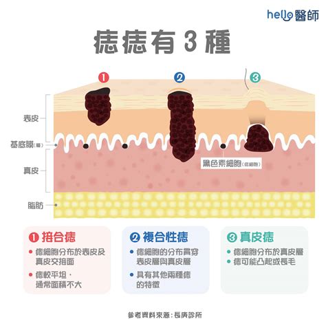 痣太多|痣形成的原因？痣長毛、痣變多變大是痣病變？5招判。